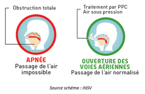 SYNDROME D’APNÉE DU SOMMEIL (SAS)